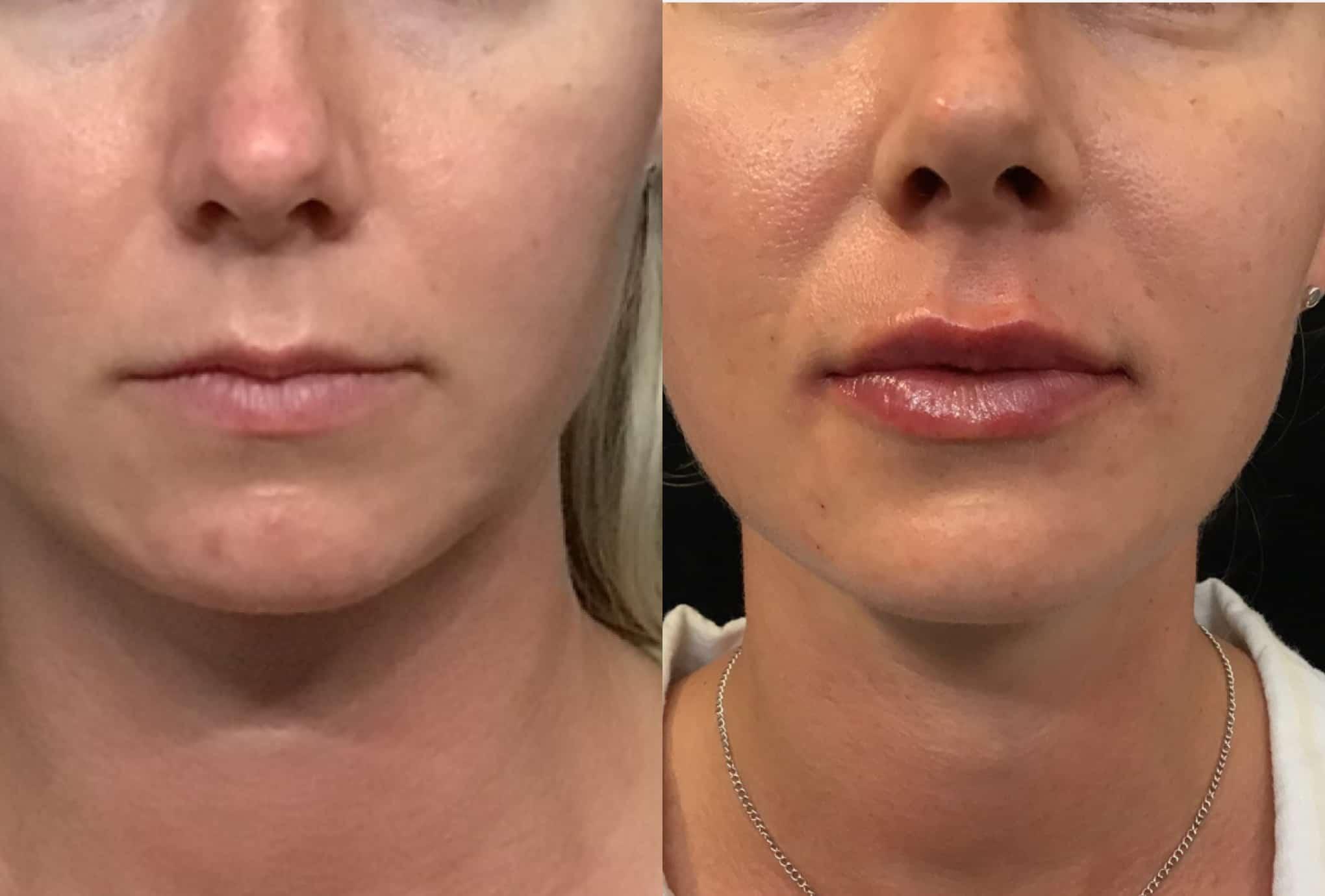 Lip Filler providing plump lips