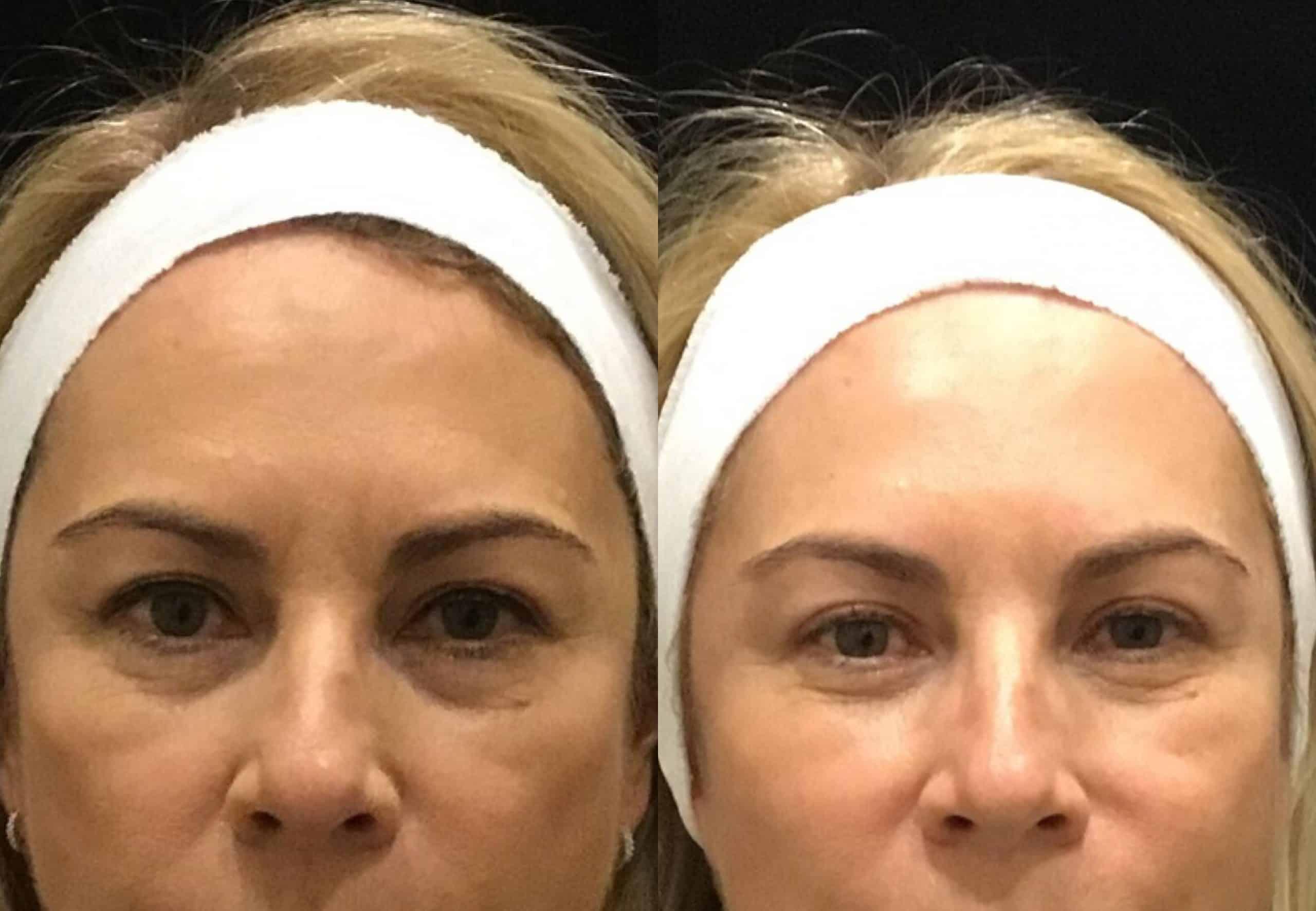 botox_prevent_wrinkles_young_women
